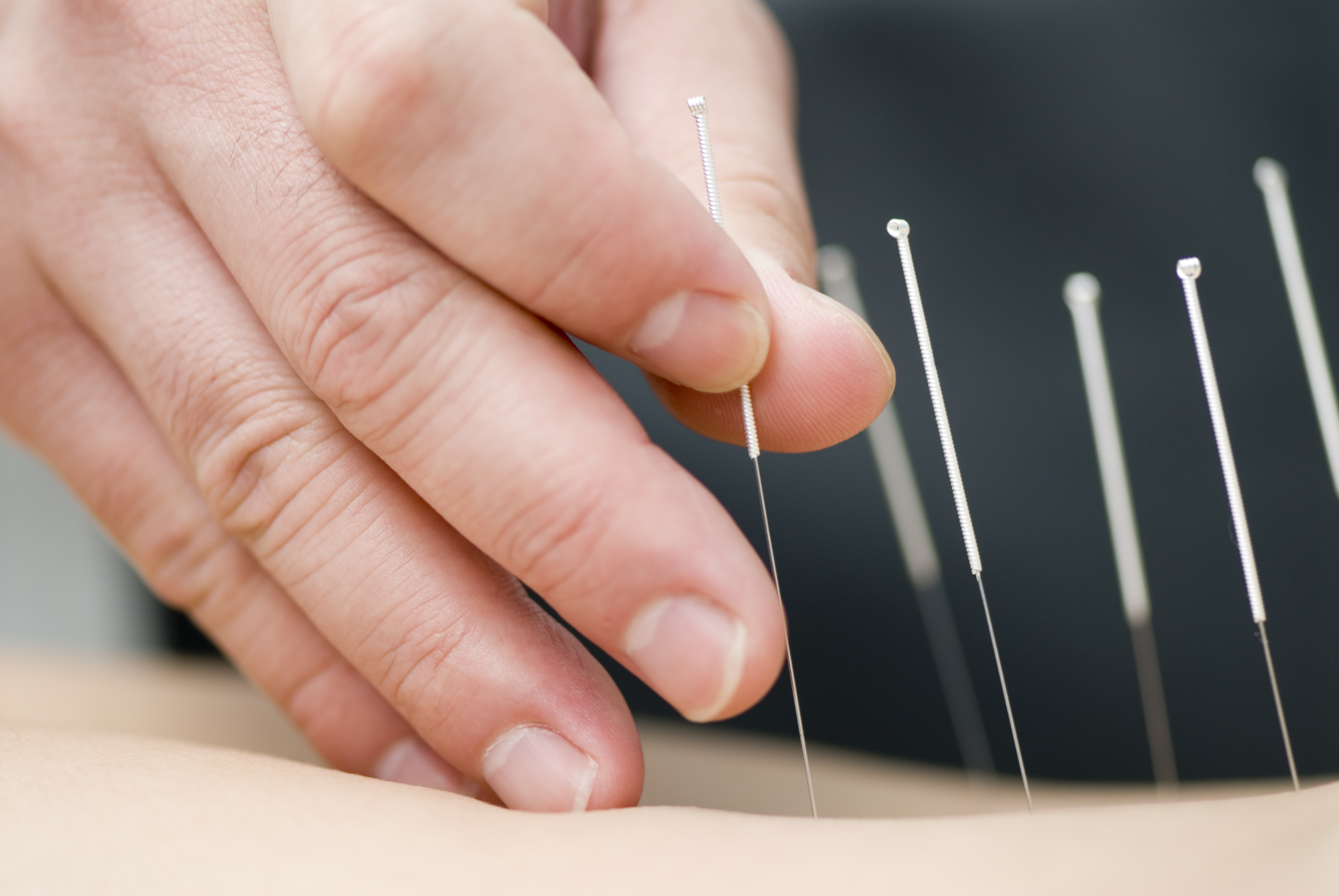 Hand applying acupuncture needles to a patient